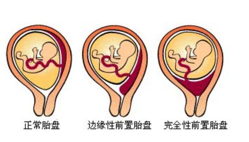 高龄孕妇生产大出血险送命,凶险性前置胎盘到底有多 凶 