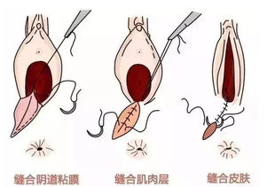 象妈妈谈顺产侧切到底有多痛 是怎么切的