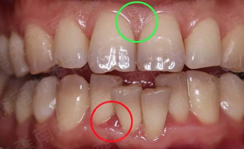 自从用了牙线后,牙龈和牙之间越来越不紧密了