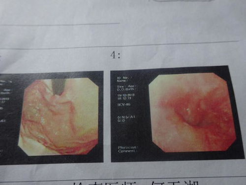 胃窦糜烂一定要做活检吗(胃窦糜烂必须做活检吗)