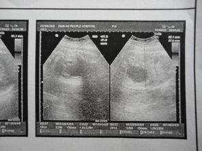 怀孕b超检查注意事项