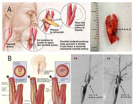 颈动脉斑块有的建议手术,有的建议吃药,啥原因 医生为您讲清楚