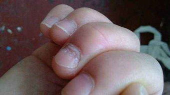 手指甲凹陷图片 指甲凹下去了是怎么回事？应该怎么办？ 