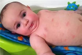 月嫂科普 湿疹 痱子 婴儿痤疮 过敏性皮疹 荨麻疹 水痘等婴儿皮肤问题的区别与护理