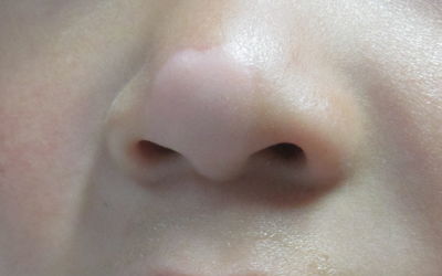 鼻梁两侧八字白斑,你知道鼻翼两侧的白色颗粒是什么吗？