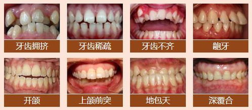 轻微牙齿不齐不想戴牙套做烤瓷牙行不行