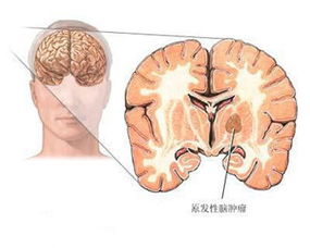 脑瘤的中医药治治疗结果果 