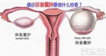 怎么治卵巢囊肿最好