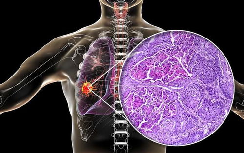 肺癌手术后看不懂病理报告单 简单学一下就能看懂,不用求医生