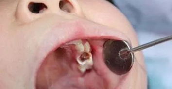 把宝宝乳牙这个问题讲透彻 内含宝宝成长护牙全计划