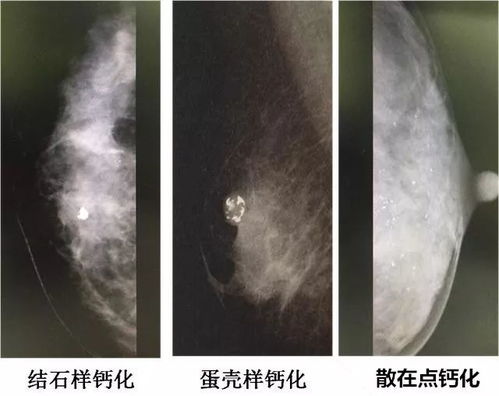 乳腺钙化灶离乳腺癌有多远