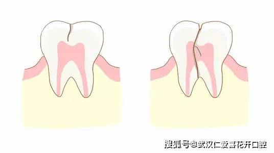 你的牙齿有核桃硬吗 牙隐裂了解一下