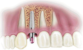 种植牙护理方法