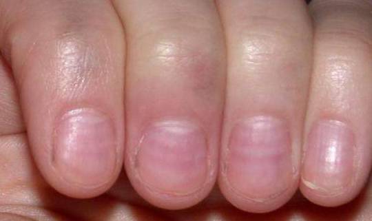 指甲月牙数量多好还是少好 指甲出现这5种形状,可能是疾病征兆