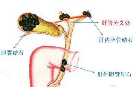 胆囊炎属重疾险 健康福重疾险 