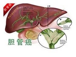 治疗胆管癌的中药