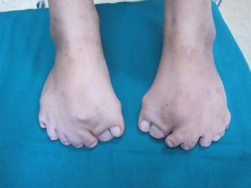 8岁女孩长15根脚趾12根手指 每天为穿鞋发愁