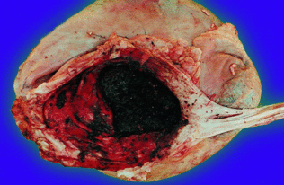 猪胃溃疡病理图片