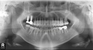 38岁 男性 种植牙案例 必立牙科