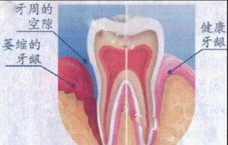 牙齿看来变长了 原来是牙龈萎缩 