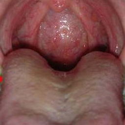 疱疹咽喉炎图片