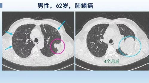 早期肺癌（原位和微浸润）使用消融术效果好么和手术相比如何(肺原位癌和微浸润的手术预后)