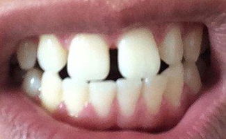 牙齿中间有缝怎么修复