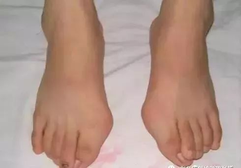 瑜伽保养你的脚 拇指外翻 扁平足 足底筋膜炎