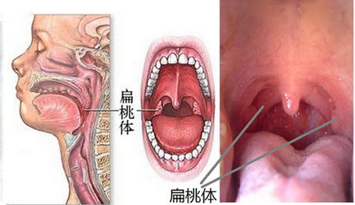 扁桃体摘除后第八天 嗓子哑 讲不出话 怎么会事