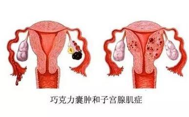 输卵管发育不良会不会影响生育，可以选择试管吗？