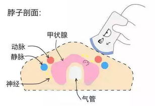 介入消融术 13分钟无痛消灭甲状腺结节