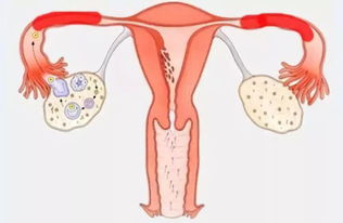 女性切除输卵管后是否还能试管婴儿的助孕治疗？