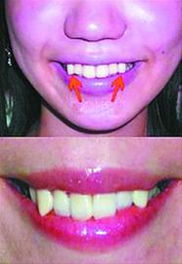 日本女性流行虎牙卖萌 将整齐牙齿整容为八重齿 