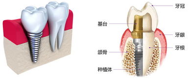 牙齿缺失 牙齿缺失怎么办 3种修复方式供你选