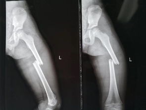 骨二科完成我院首例儿童股骨骨折闭合弹力髓内钉内固定手术