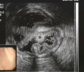 超声胃镜考虑什么