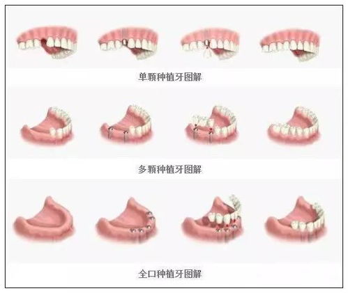 最全的口腔种植牙介绍,值得收藏给患者科普