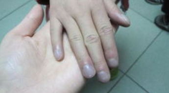 手指甲发紫(手指甲变乌紫色是什么原因)