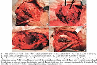 韦兴 两种不同微波灭活技术在肢体骨巨细胞瘤治疗中的比较.365医学网 