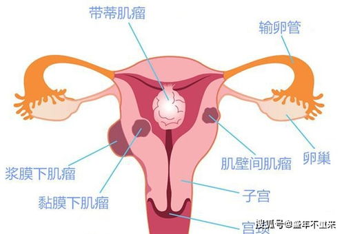 吃水果吃出肌瘤 便秘 腹泻 闭经,原来是生冷惹的祸