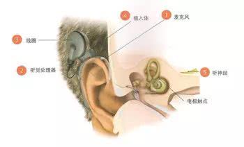 人工耳蜗的基本结构包括哪些？