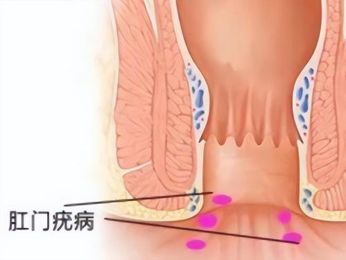 肛门掉出粉色小肉球,不痛不痒,怎么办 教你3个方法自我调理