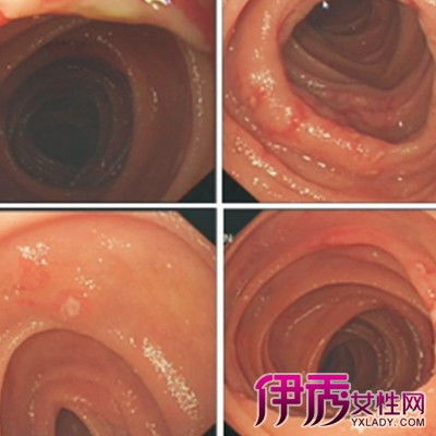 肠镜的临床意义 