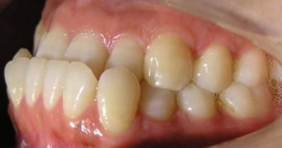 牙齿畸形请教长沙最好的矫正牙齿的医院 