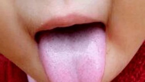 肺癌患者舌头红是什么症状