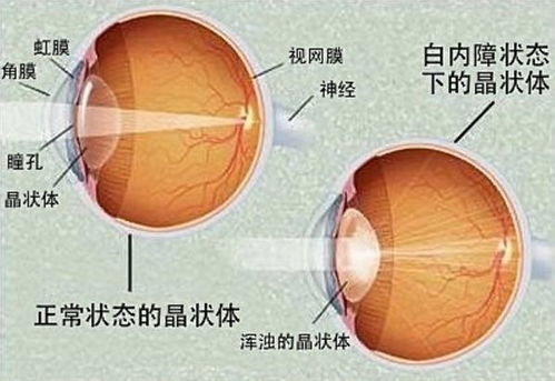 北京美尔目提醒白内障没有特效药