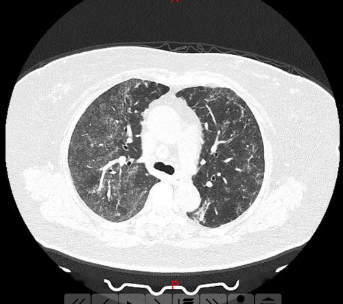 正常人有必要做肺部ct吗肺部阴影可能是哪些疾病