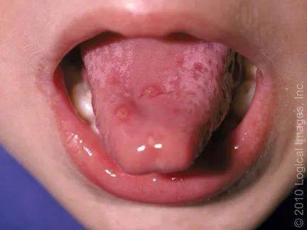 舌头溃疡舌根图片