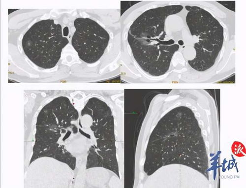 37岁女子车祸入院,CT筛查新冠肺炎反 揪 出早期肺癌