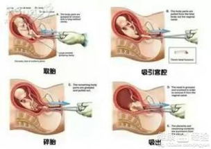 人工流产后症状如何治呢